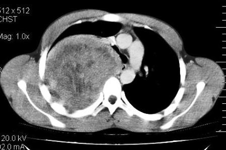 Figure 3: Erosion and involvement of posterior aspect of right fifth rib
